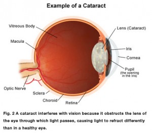 cataract-example